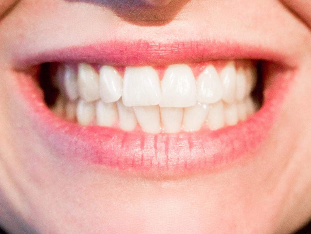 woman with whitener teeth